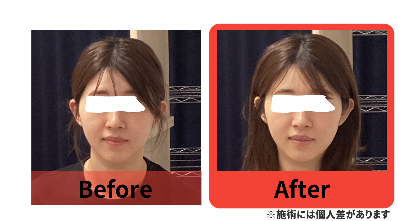before　after　小顔矯正　湯島　上野　改善　たるみ