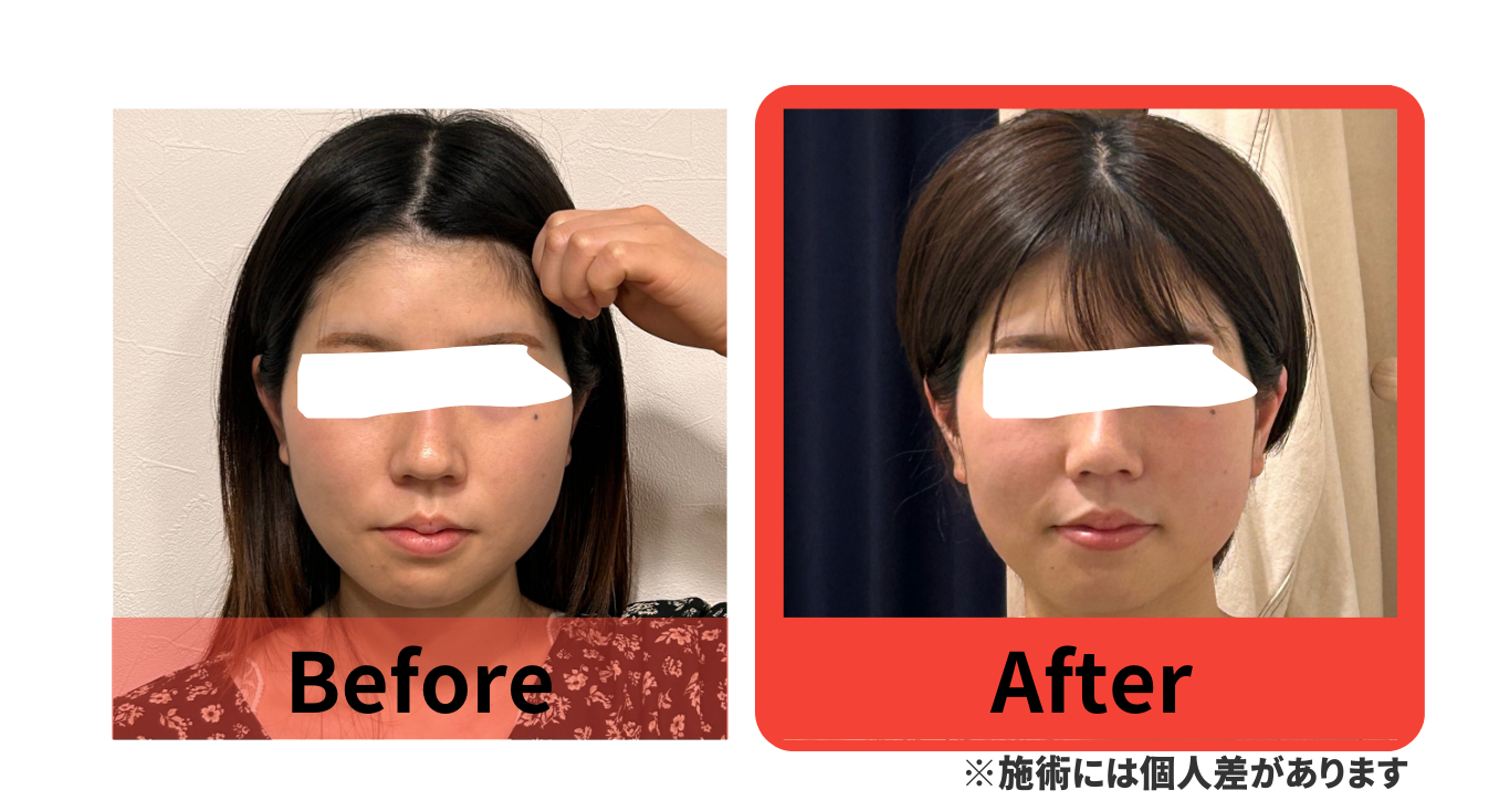 before　after　小顔矯正　湯島　上野　改善　たるみ