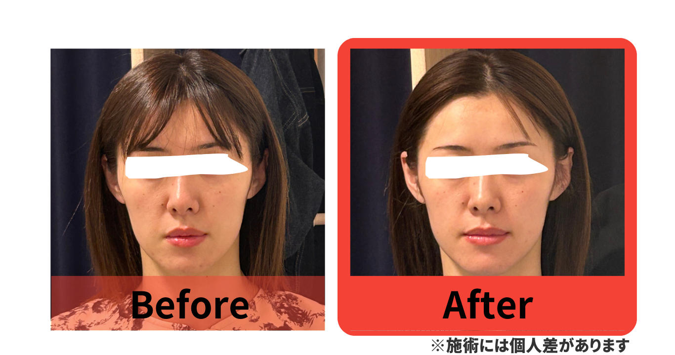 before　after　小顔矯正　湯島　上野　改善　たるみ