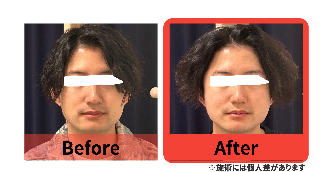 before　after　小顔矯正　湯島　上野　改善　たるみ